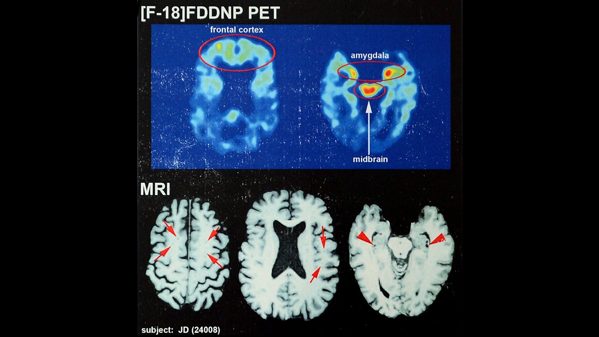 Aiming to âmake the game safer,' new BU study shines light on CTE in football