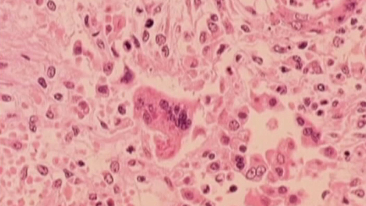 Mass. health officials warn of possible measles exposure in multiple locations