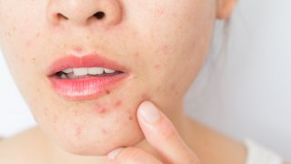 File image of a woman with acne on her face.