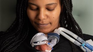 Helen Woldemichael delivered her daughter Amari at 25 weeks gestation.