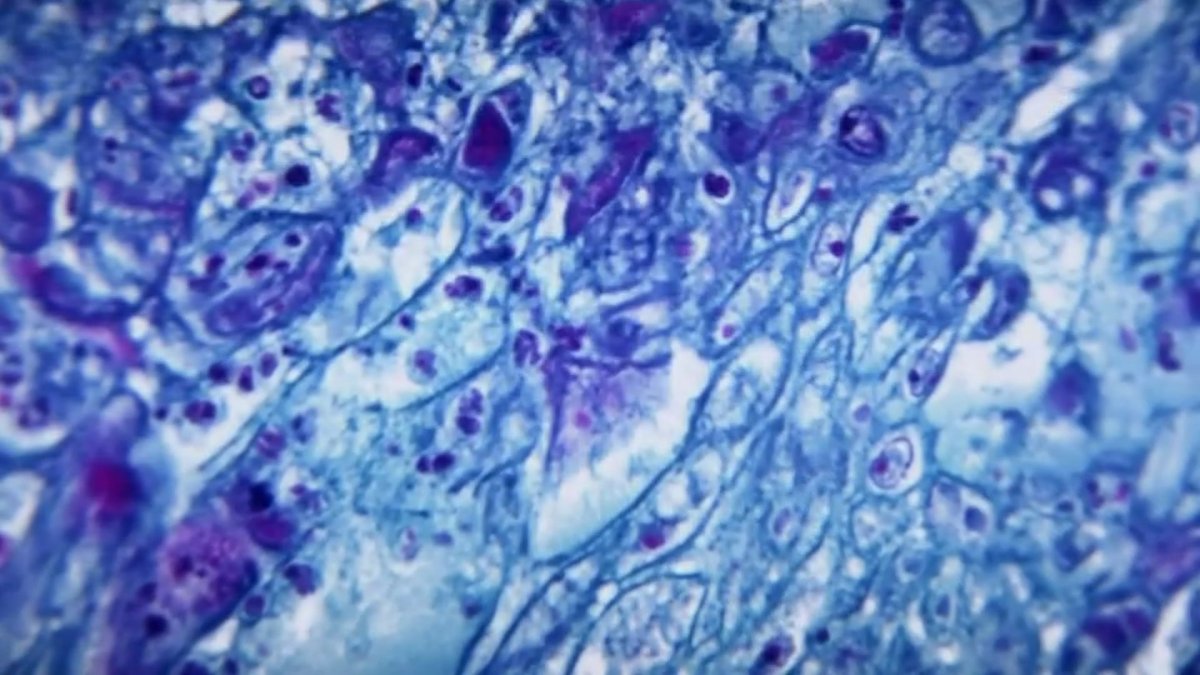 Monkeypox in Mass.: 2 More Cases Confirmed – NBC Boston - Vimarsana News
