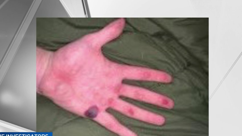 Recruit's Blistered Hand Tied to Fallout at Mass. State Police Academy