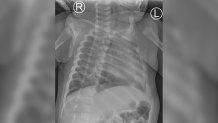 The x-ray of Cal's rib injury
