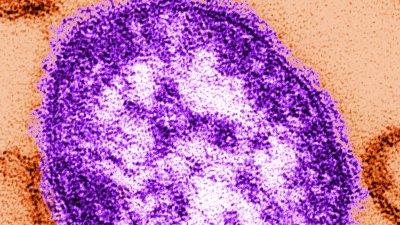 Chicago measles outbreak spreads as case count surpasses 50