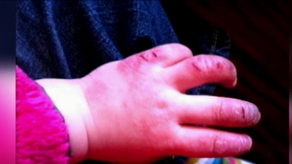 Eczema’s Cause Could Be in the Air We Breathe NBC Boston