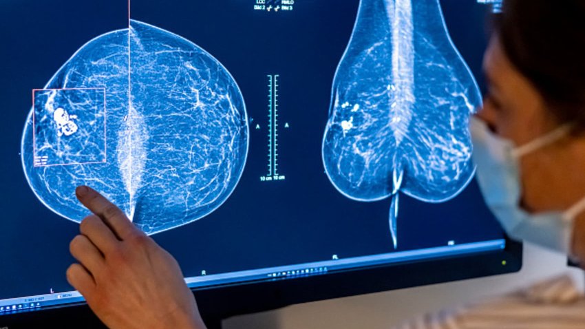 Medical personnel use a mammogram to examine a woman’s breast for breast cancer.