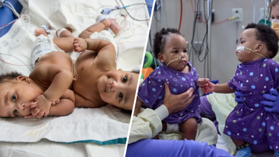 Conjoined twins successfully separated at CHOP