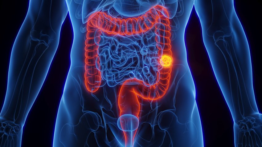 Colon cancer, illustration