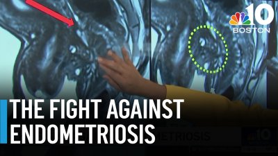 Endometriosis patient: ‘Don't stop asking questions until you have an answer'