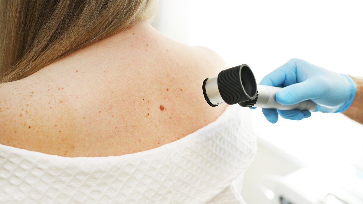 A dermatologist says this 'big sign' can mean a mole is melanoma