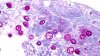 At least 9 cyclospora illnesses tied to NH hospital cafeteria food, officials say