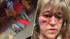 Woman says she had seizure after Gloucester attack left her bitten and bruised